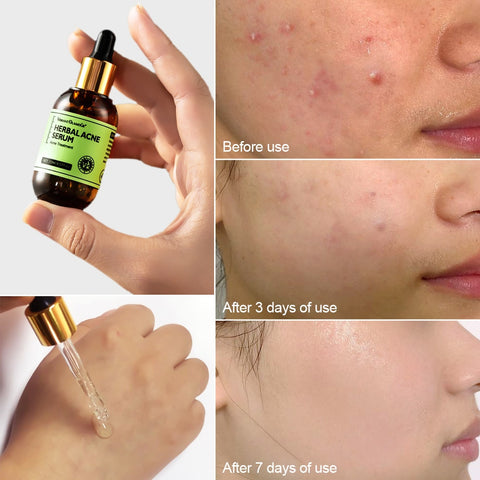 Acne Treatment Suit