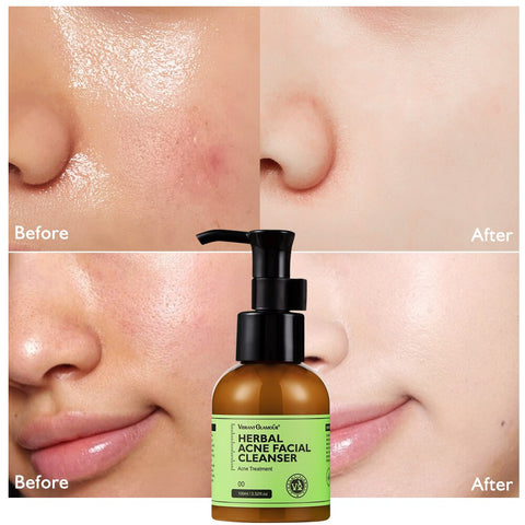 Acne Facial Cleanser