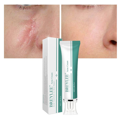 Marks Removal Cream