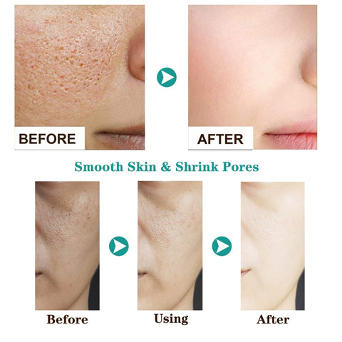Acne Face Cream
