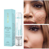 Acne Face Cream