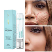 Acne Face Cream