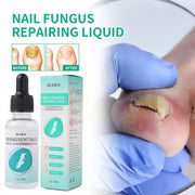 Nail Fungal Treatment